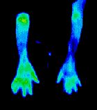 arthritis_hands_after_140 arthritis_hands_after_140